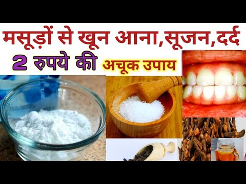 मसूड़ों से खून रोकने के घरेलू तरीके - Home Remedies for Gums Bleeding in Hindi -  मसूड़ों में सूजन