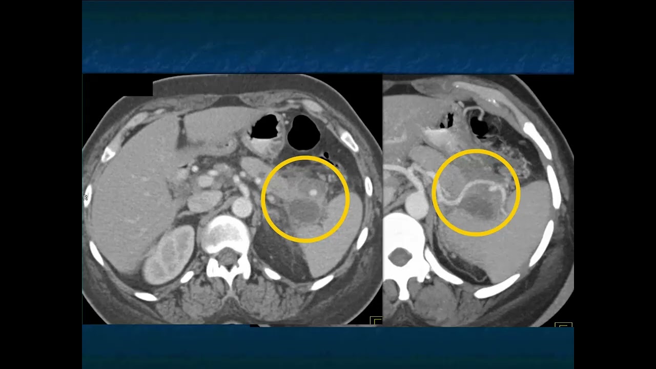 MDCT Evaluation of the Spleen: Challenges in Diagnosis - Part 5