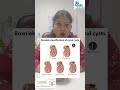 awareness on renal cysts#femaleurologist #renalcyst #apollo #doctor #
