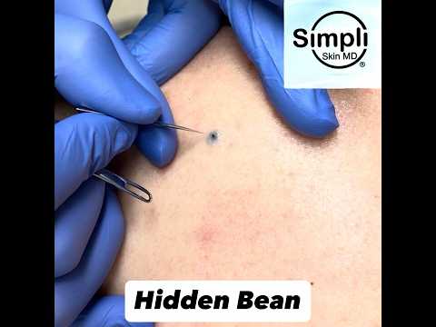 Dilated Pore Extraction