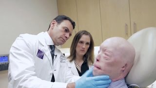 Face transplant recipient speaks one year after surgery