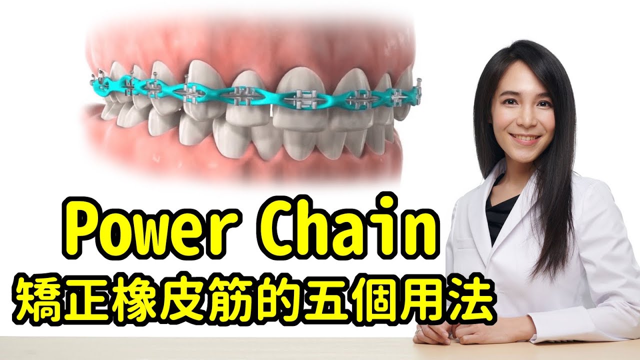 牙齒矯正power Chain橡皮筋關縫原理及五大用法 會不會痛 會染色 戴多久 斷了怎麼緊急處理 林榆芩醫師 Youtube