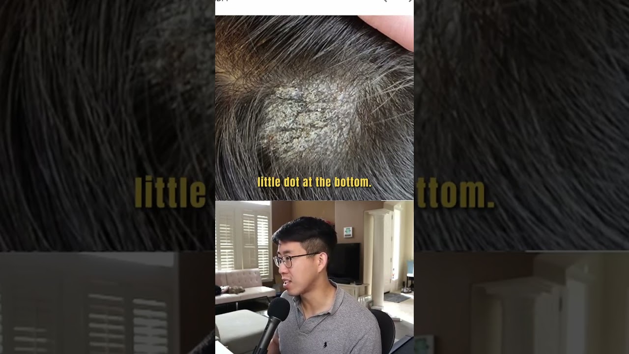A 10 Year Old Boy Comes To Clinic With Scalp Itching And Flaking #medicine #meded #doctordle