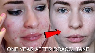ONE YEAR AFTER ROACCUTANE | MY SKIN NOW