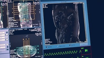non ce MRA renal angiography on GE 1.5t with sequence details n post processing