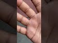 This Part Of Losing Weight Sucks