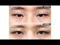 [B&amp;A] 남자 무쌍눈매교정, 졸린눈｜절개눈매교정+윗트임_2개월