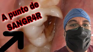 👄Caries CERCA del NERVIO 🚨 (bases para protección pulpar)💙 by ESPECIALIDADES ODONTOLOGICAS 334,184 views 3 years ago 11 minutes, 31 seconds