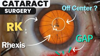 今日の眼疾患治療指針 = Today's Therapy in Ophthal… Minimal lower eyelid epicanthoplasty combined with thermal