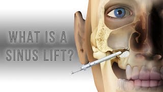 What is a sinus lift?