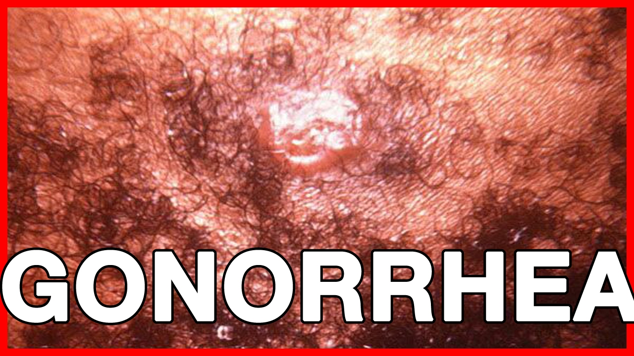 gonorrhea symptoms pictures