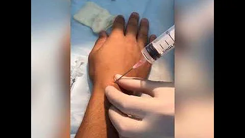 Пункционной метод  лечение гигромы кисти в Уфе