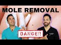 HOW TO REMOVE AN UNWANTED MOLE | DERMATOLOGIST PERSPECTIVE