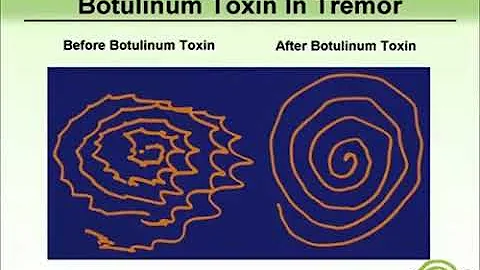 Essential Tremor Treatment With Botulinum Toxin, w...