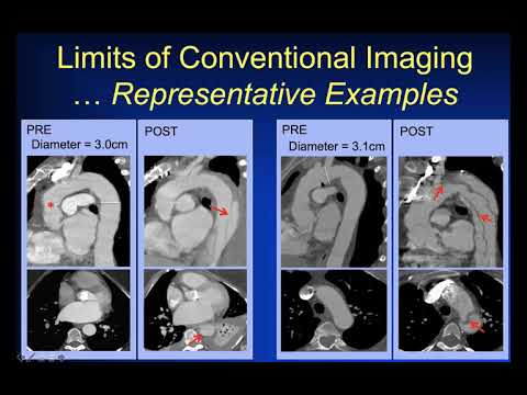 Imaging Marfan Patients