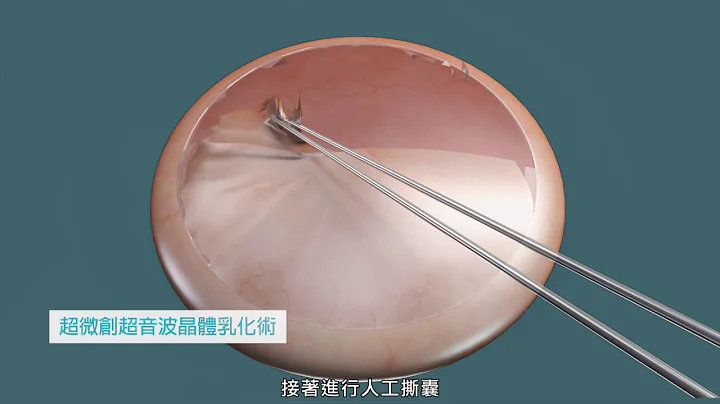 【白內障治療流程】超微創超音波晶體乳化術 - 天天要聞