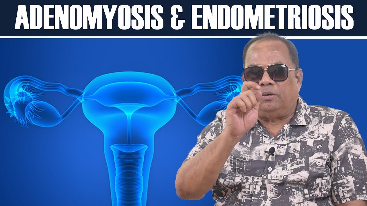 Аденомиоз и эндометриоз / ХКН