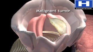 What is malignant tumor - How malignant tumor diagnosed - Malignant tumor vs benign tumor