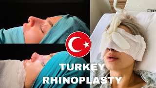 RHINOPLASTY (NOSE JOB) EXPERIENCE IN TURKEY | DR. ERDEM ÇAĞLAR