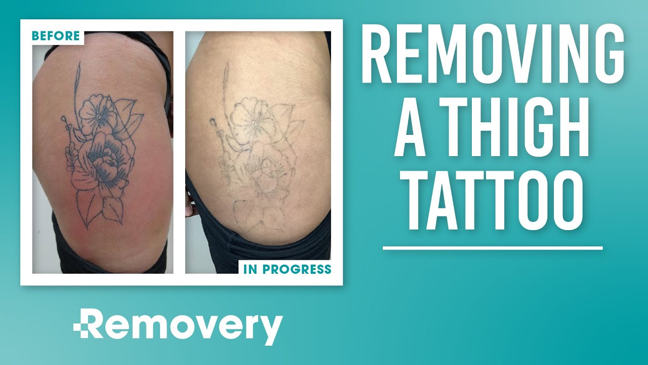 Best Tattoo Removal near Bade Patrick G in Darwin Northern Territory - Yelp