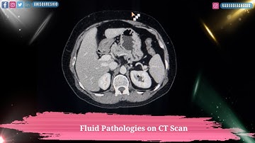 Fluid Pathologies in CT Scan | By Anis Qureshi