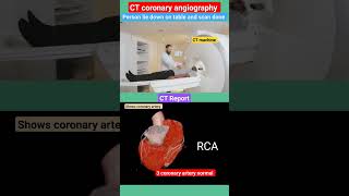 CT CORONARY ANGIOGRAPHY SHORTS viralshorts youtubeshorts CTAngiography heart healthtips