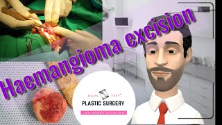 LIVE:Surgical technique of HAEMANGIOMA excision from lip in3minutes only, PLASTIC SURGERY MADE EASY.