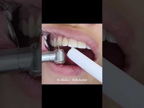 لحظه ای که در درمان ارتودنسی انتظارش و میکشین متخصص ارتودنسی دکتر علیرضاخدیوی
