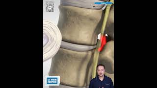 Slip Disc | Dr. (Prof.) Varun Agarwal