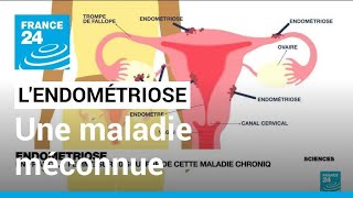 L'endométriose : une maladie méconnue qui touche 10 % des femmes • FRANCE 24