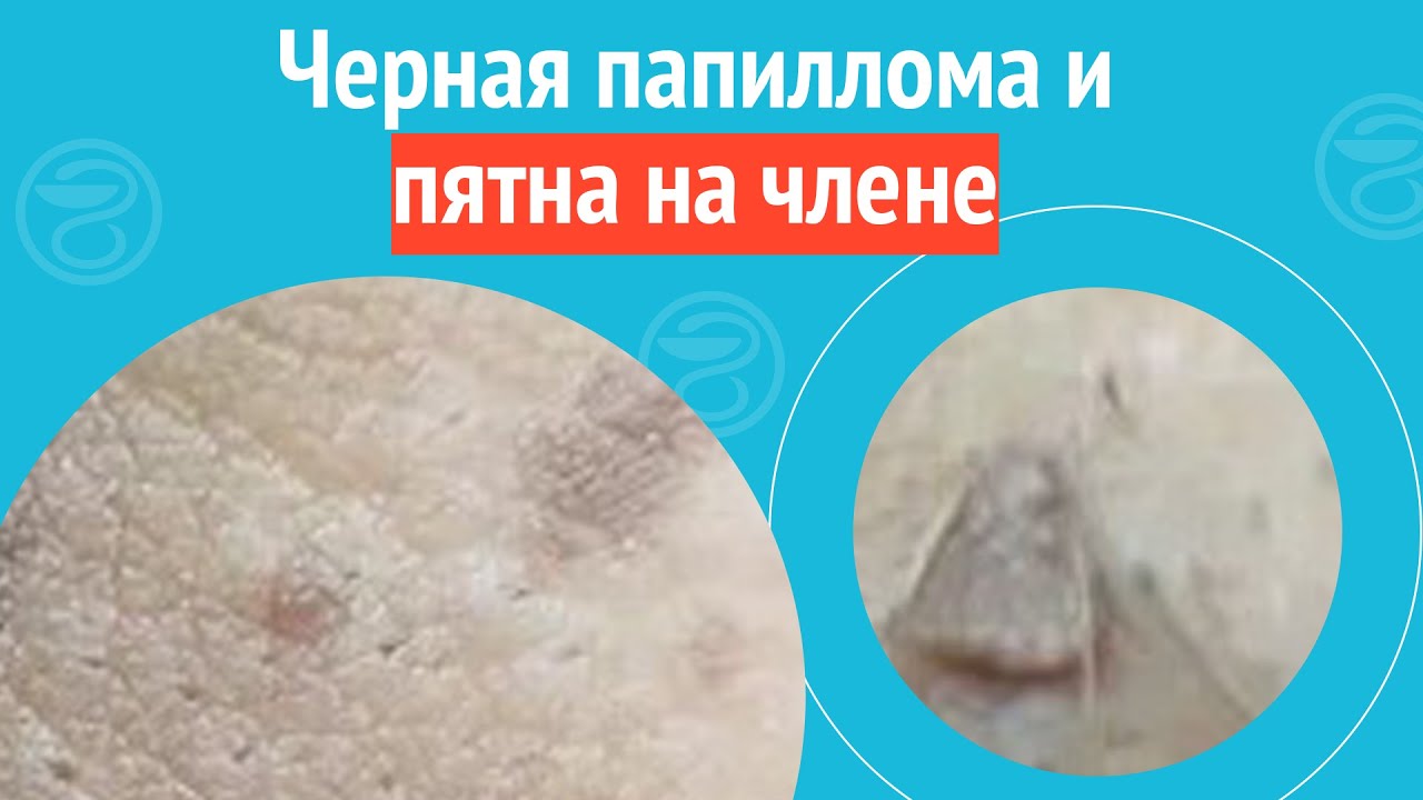 😲 Черная папиллома и пятна на члене. Клинический случай №1172 - YouTube