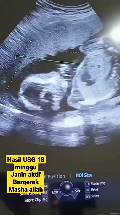 Hasil USG 18 Minggu Aktif BerGerak