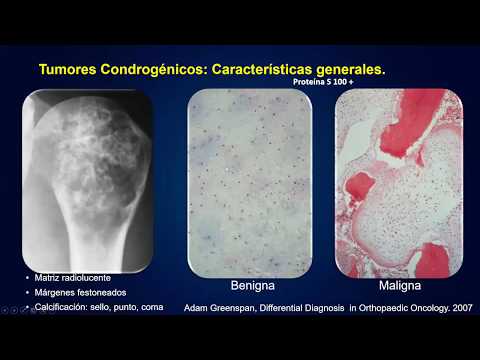 Vídeo: Remodelación De La Matriz Tumoral E Inmunoterapias Novedosas: La Promesa De Biomarcadores Inmunes Derivados De La Matriz