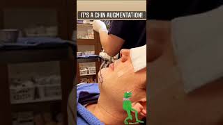 Chin Augmentation Procedural Video