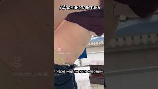 #абдоминопластика#липосакция#