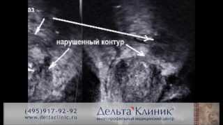 ТРУЗИ предстательной железы. Трансректальное УЗИ простаты в Дельта Клиник ТРУЗИ предстательной железы. Трансректальное УЗИ простаты в Дельта Клиник