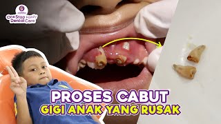 CABUT GIGI ANAK GAK PAKAI LAMA DI KLINIK GIGI JOY DENTAL