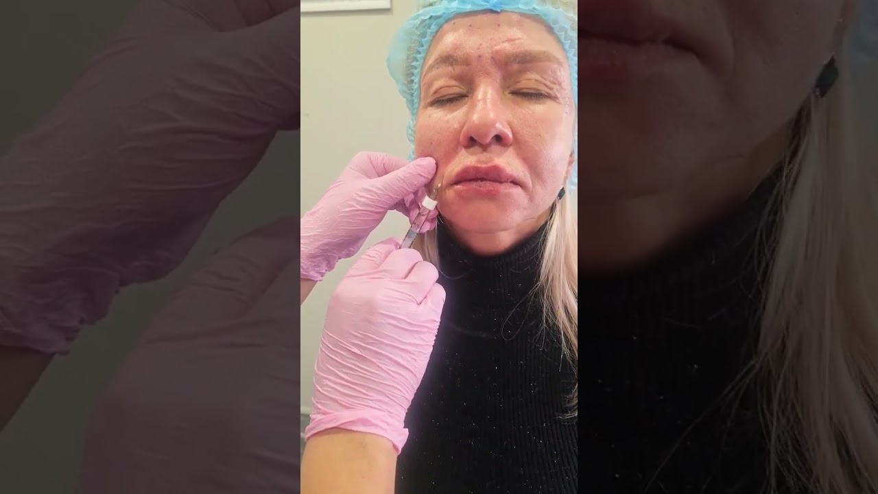 Заполнение носогубных складок.Аспирационная проба👌