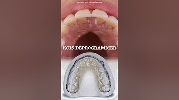 Kois Deprogrammer Demystified