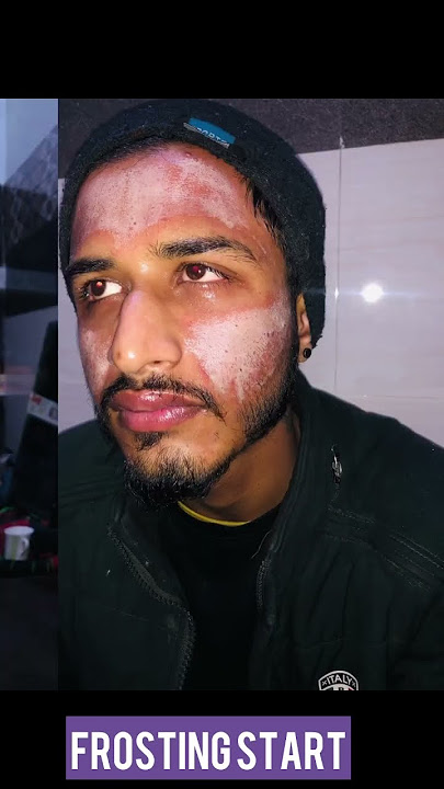 25%TCA Peel Application At Home First Sitting #acne #skincare #acnetreatment #skin #youtubeshorts 🧪