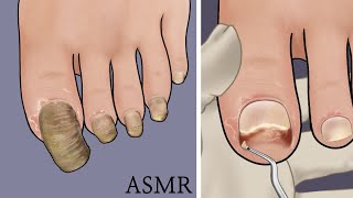 [ASMR] 딱딱하고 휘어진 무좀발톱 치료 애니메이션 / Athlete&#39;s foot toenails treatment animation