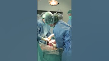 C-section #shorts #birth