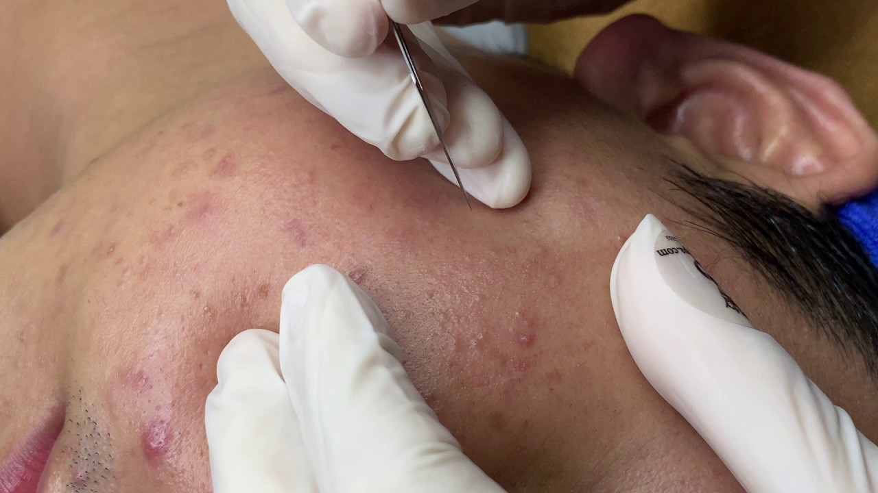 How To Get Rid Of A Pimple Under The Skin | Loại Sạch Mụn Ẩn Dưới Da - SacDepSpa#178
