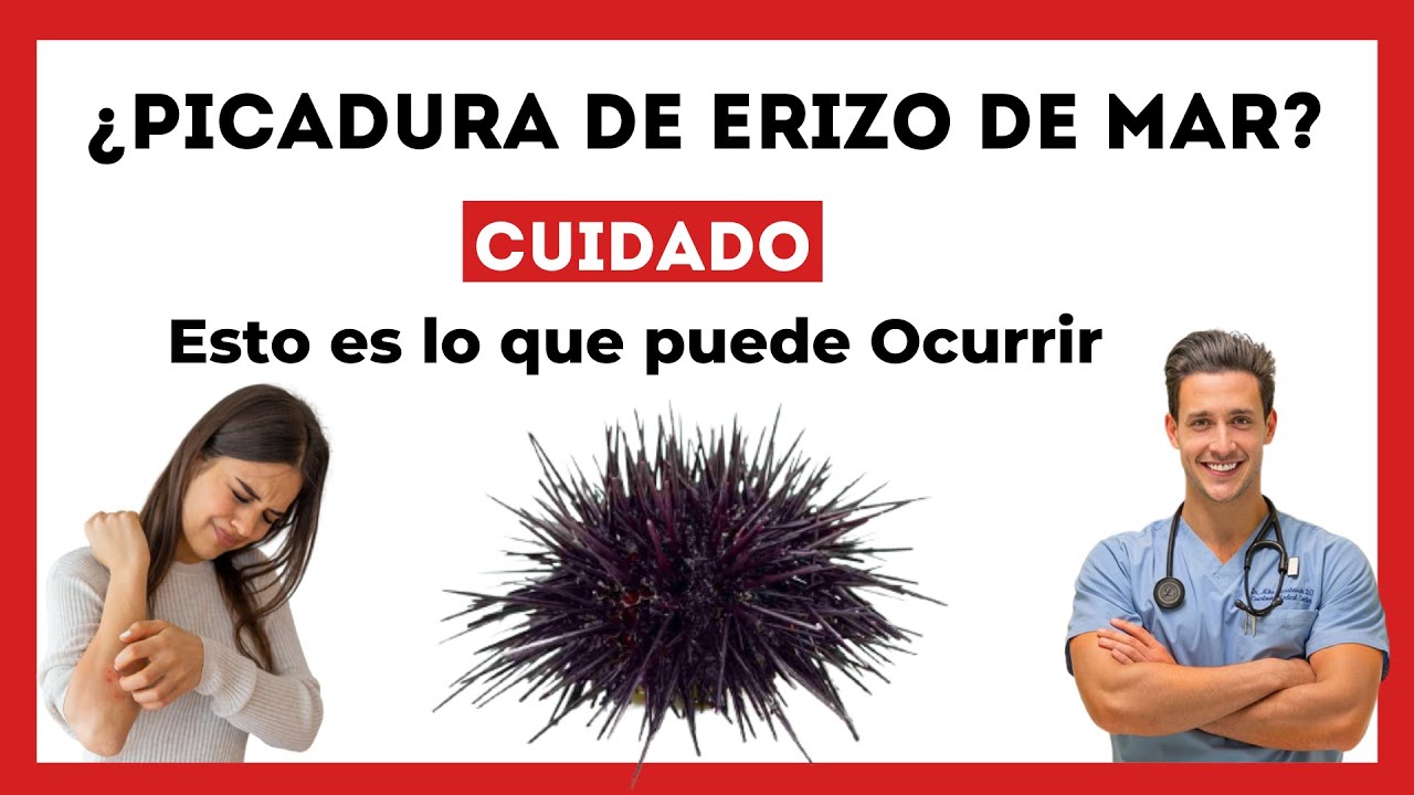 😨 Qué Pasa si te PICA un Erizo de Mar [Esto es lo que puede OCURRIR a
