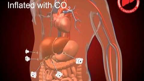 Laparoscopic Liver Resection  ( By Gujarat Liver Cancer Clinic - Dr. Hitesh Chavda)