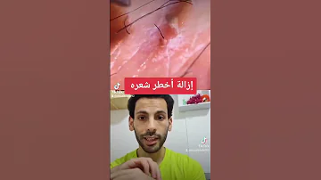 ازالة اخطر شعره تحت الجلد Entfernen Der Gefährlichsten Haare Unter Der Haut علاء خلف المانيا 