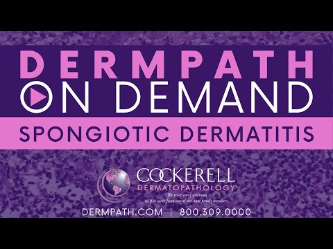 Spongiotic Dermatitis