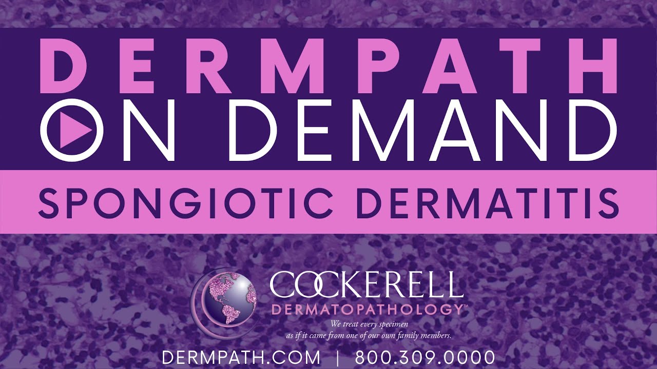 Spongiotic Dermatitis YouTube