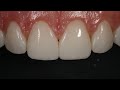 Resin Veneering and Diastema Closure with Dr. Dennis Hartlieb