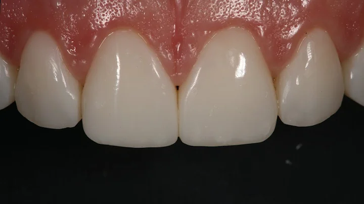 Resin Veneering and Diastema Closure with Dr. Denn...